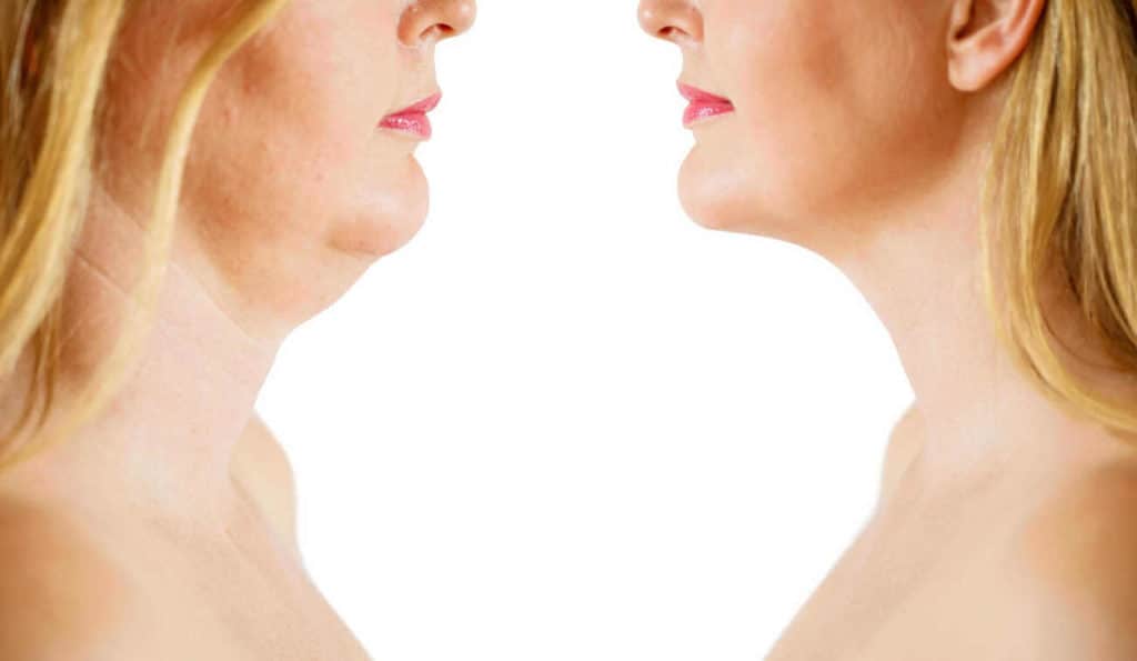 Double Chin treatment Oxfordshire before and after results