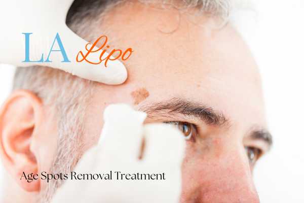 What Are the Most Effective Treatments for Age Spots Oxfordshire?