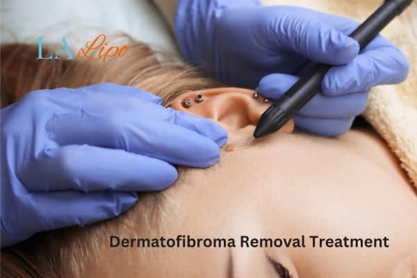 Dermatofibroma Removal Treatment Oxfordshire