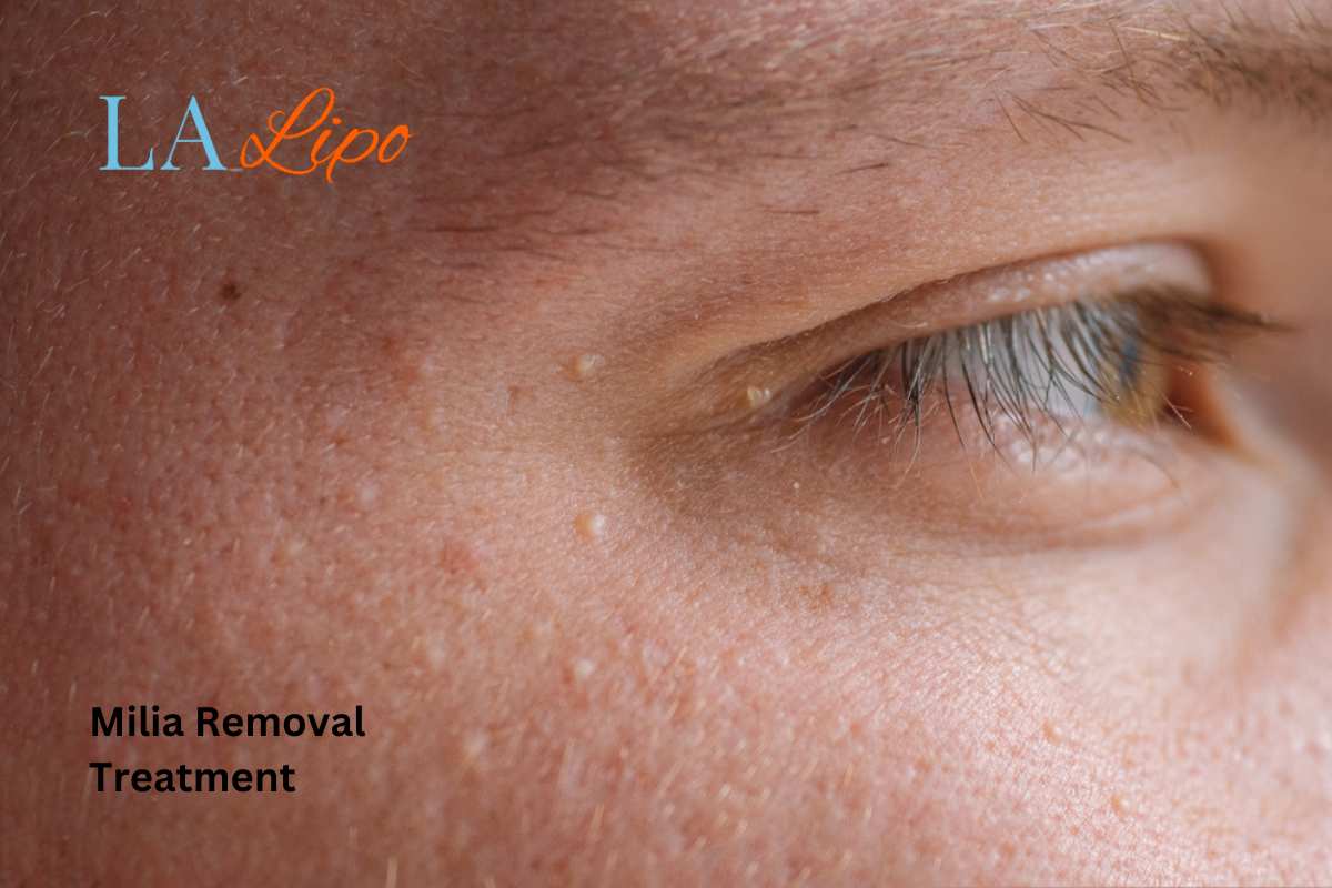 Cryopen Milia Removal: Is It the Easiest and Safest Option Oxfordshire?