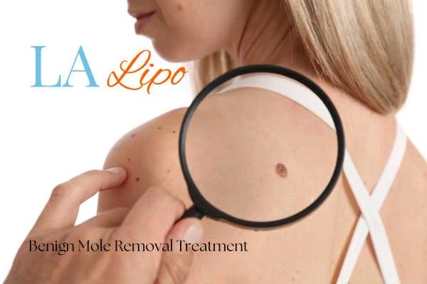 Why getting moles removed Oxfordshire can boost your confidence!