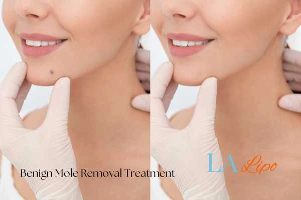 Woman's before and after results of being moles removal treatment Oxfordshire