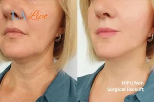 hi-fu for wrinkles Oxfordshire before and after results