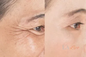 Before and after results of woman - HI-fu wrinkles reduction treatment Oxfordshire