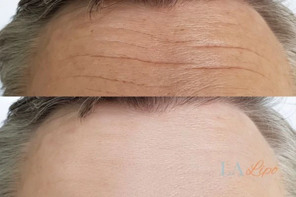 results of HIFU Oxfordshire on mans forehead to help reduce lines and wrinkles