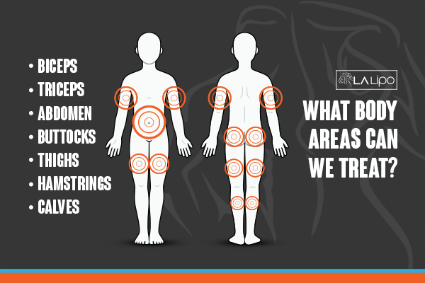 Graphic to show areas you can have LA-EMS Body Sculpting Oxfordshire treatment.