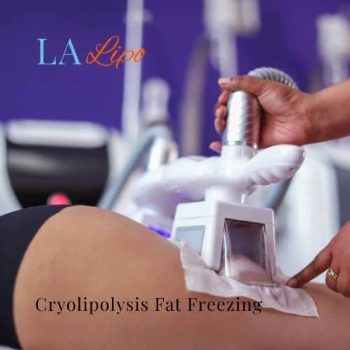 fat freezing - Cryolipolysis Oxfordshire