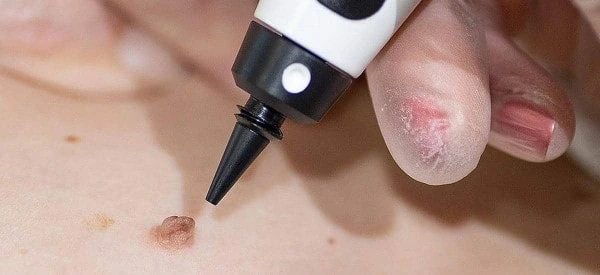 skin tag removal using cryopen Oxfordshire