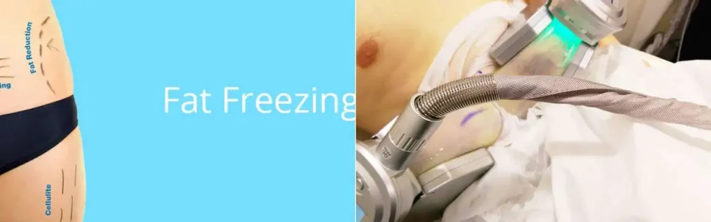 Fat freezing Oxfordshire on multiple areas of the body