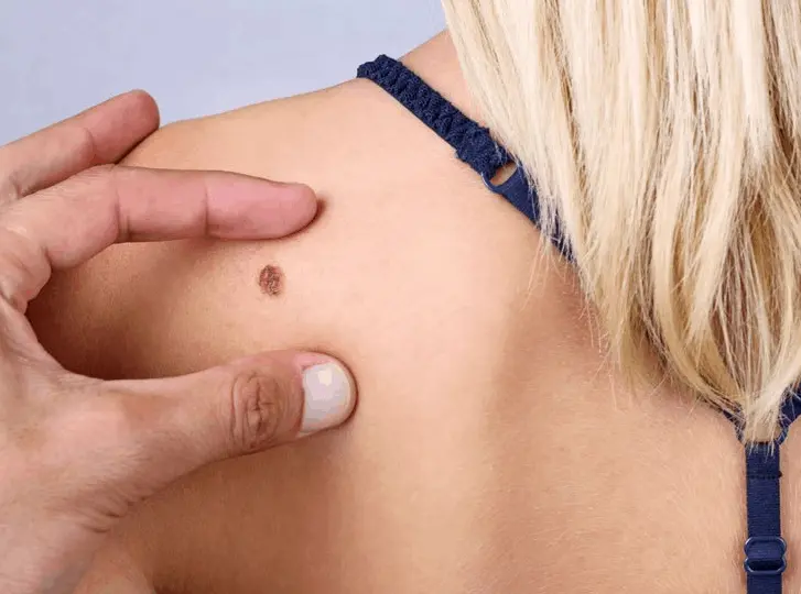 woman having mole removal Oxfordshire consultation before treatment.