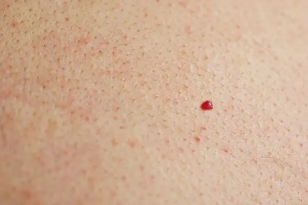 close up of a cherry angioma Oxfordshire