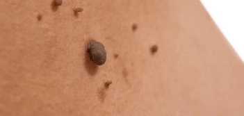 image of a skin tag Oxfordshire