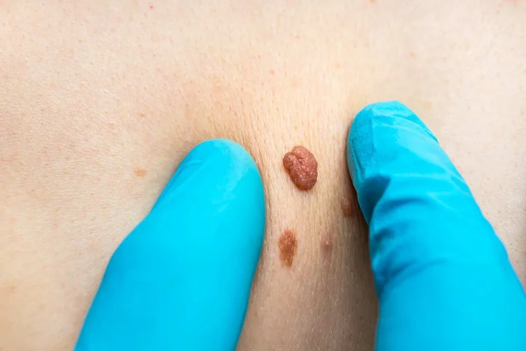Consultant examining a skin tag Oxfordshire