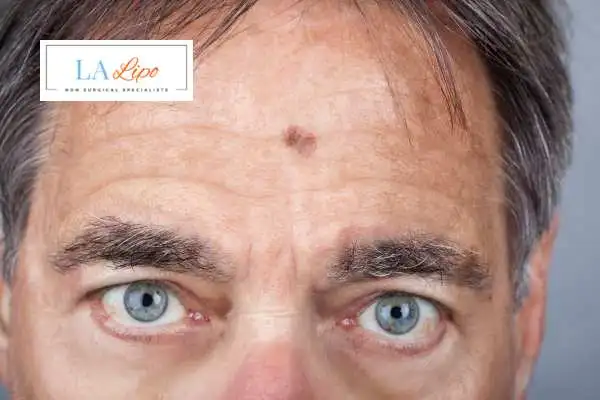 Solar Lentigo Removal Oxfordshire image of man with mark on his forehead