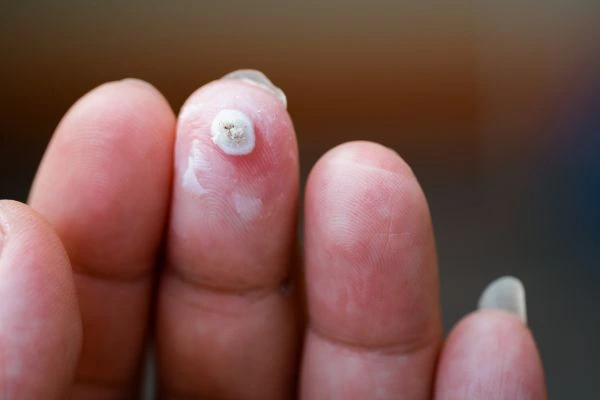 wart on person finger - cryotherapy to treat from LA LIPO Oxfordshire