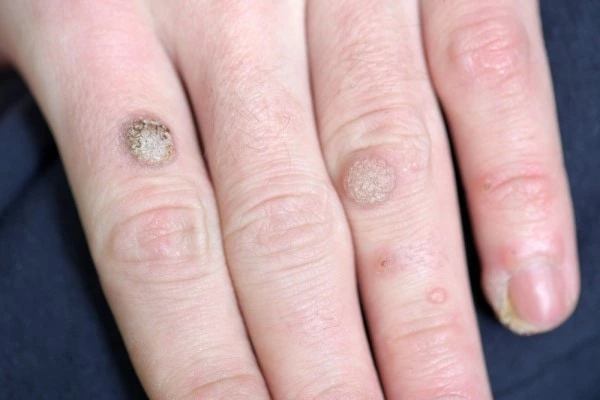 photo of warts on person hand - see wart removal Oxfordshire from LA LIPO
