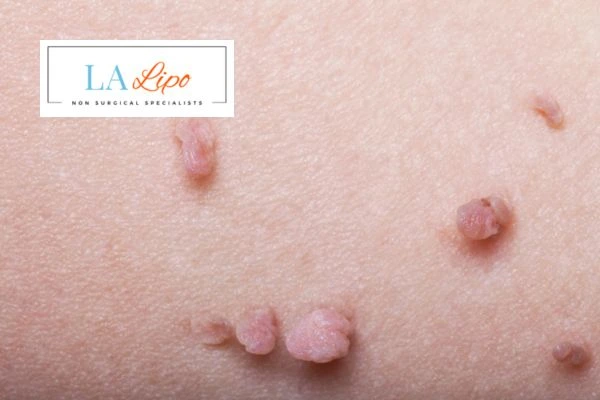 Does cryopen skin tag removal Oxfordshire hurt? Find out now call our team today!