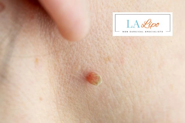 Book skin tag removal Oxfordshire today speak to our team now!