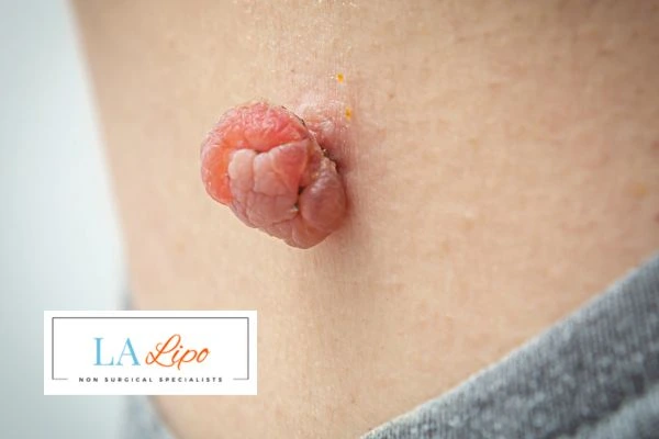 Interested in skin tag removal Oxfordshire? Concerned about the pain? Find out more today!