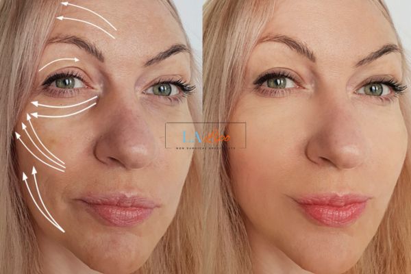 Morpheus 8 results Oxfordshire face lift.