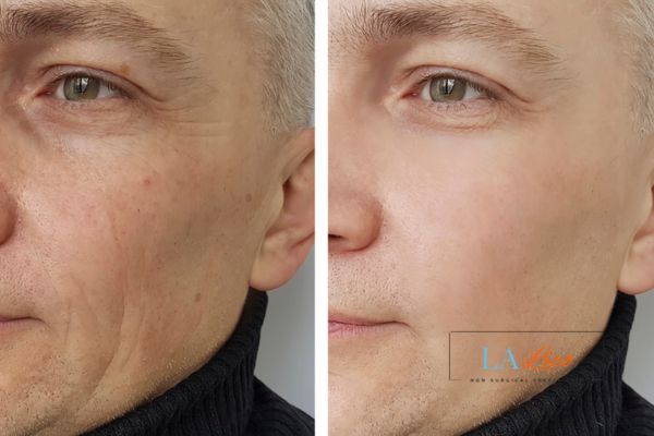 See the amazing results of Morpheus8 Treatment Oxfordshire!