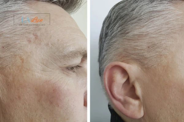 Mens Before & After Morpheus 8 Results Oxfordshire