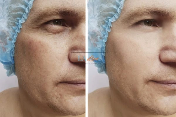 Before and after Morpheus 8 Results Oxfordshire