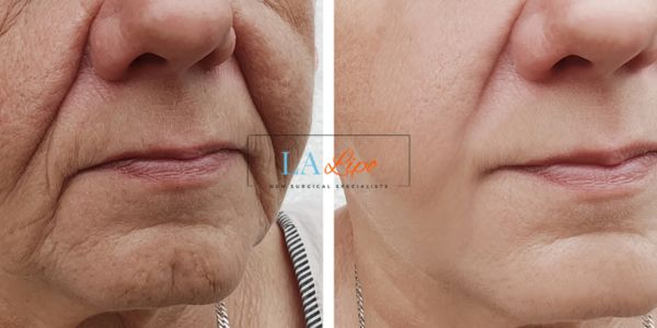 Older lady deeper wrinkle reduction - LA LIPO Morpheus 8 Results Oxfordshire