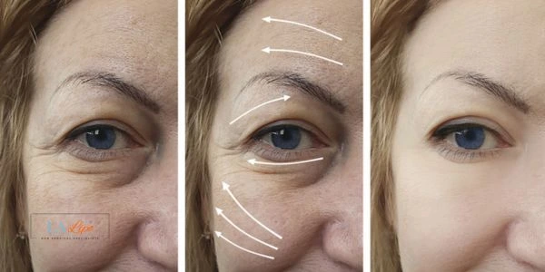 Amazing eye lift Morpheus 8 results Oxfordshire