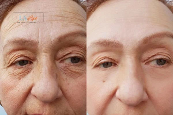 The powerful benefits of Morpheus8 Treatment Oxfordshire - Call Our team today!