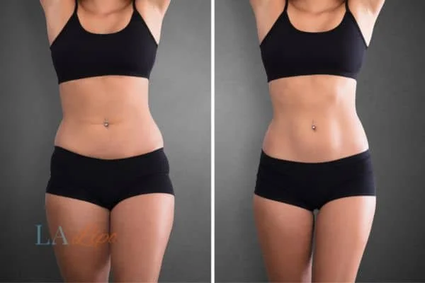 before and after results of non-surgical treatment to help a woman's body image and mental health Oxfordshire
