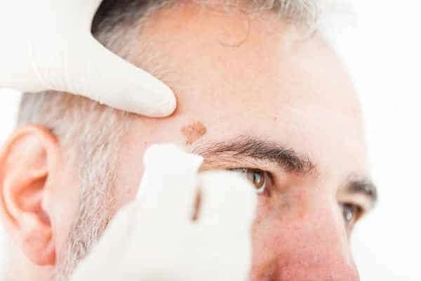 Age spots and elderly people Oxfordshire what is the link?