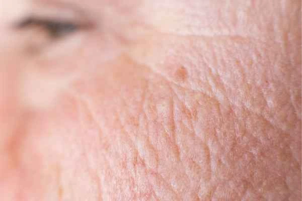 close up picture of a woman's face showing an age spot Oxfordshire