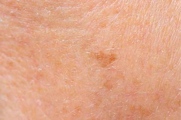 close up picture of age spots Oxfordshire