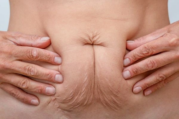 Image of a woman's stomach with loose skin - example of skin tightening Oxfordshire options