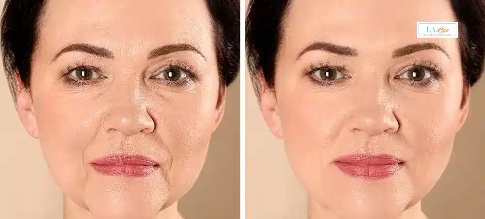 How Long Does It Take to See Results and How Long Do They Last Oxfordshire?
