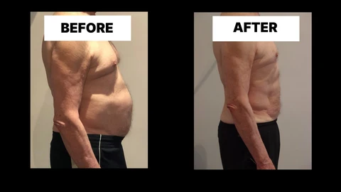 What Symptoms Can Diastasis Recti Cause in Men? Weak Core, Back Pain and Poor Posture Oxfordshire